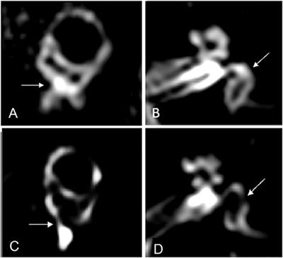 Advanced Imaging of the Vestibular Endolymphatic Space in Ménière's Disease